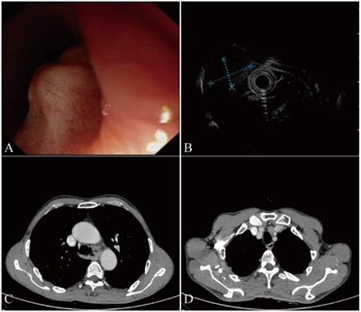 Case report: A case of esophageal small cell carcinoma misdiagnosed as leiomyoma